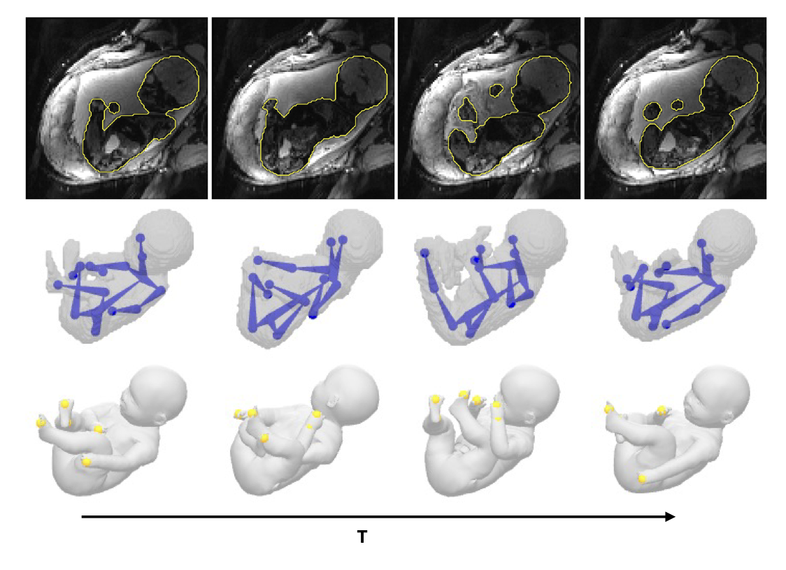 Figure from: Fetuses Made Simple: Modeling and Tracking of Fetal Shape and Pose