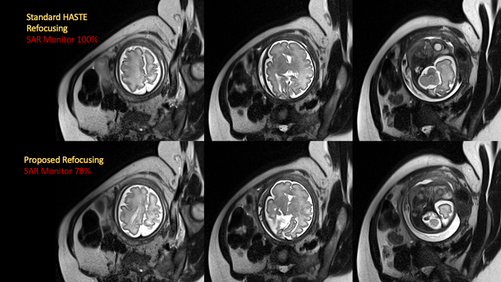 Figure from: Design of Novel RF Pulse for Fetal MRI Refocusing Trains using Rank Factorization (SLfRank) to Reduce SAR and Improve Image Acquisition Efficiency